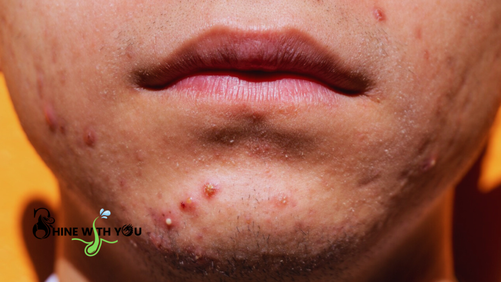 Acne